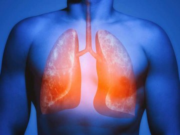 Covid-19 pode deixar problemas crônicos nos pulmões e outros órgãos, como a fibrose pulmonar